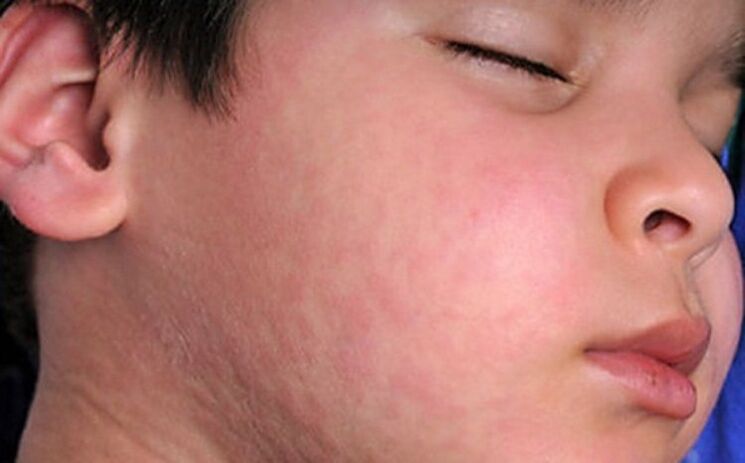 Allergic rash on the skin - a symptom of the presence of parasites in the body