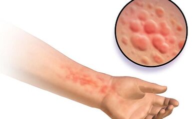 The manifestations of human schistosomiasis